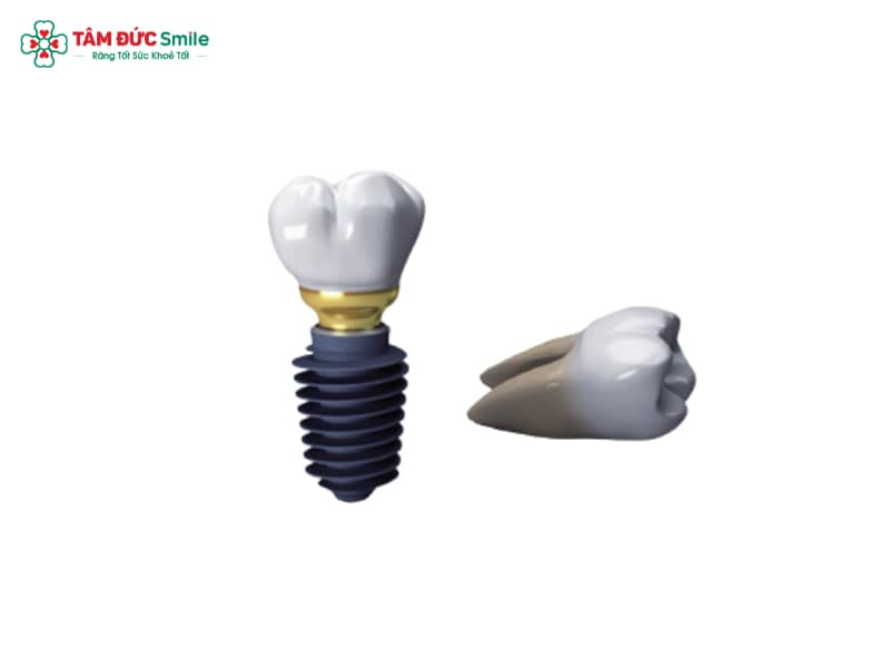 Trụ Implant Megagen Hàn Quốc: Đặc điểm, giá và công dụng