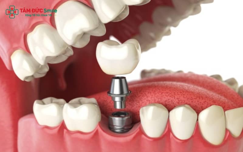 Implant Neodent được phát triển bởi Tập đoàn Straumann danh tiếng của Thụy Sĩ