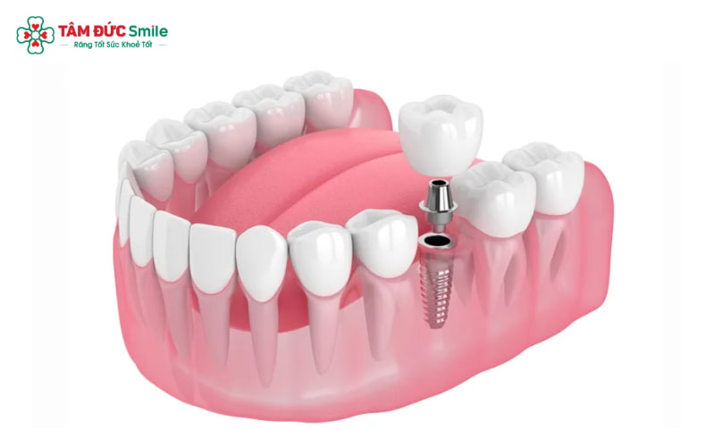 Trụ implant Neodent có thiết kế tinh xảo, khớp nối Abutment liên kết chắc chắn 