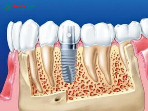Trụ Implant Neodent: Xuất xứ, Ưu điểm và Công nghệ hiện đại
