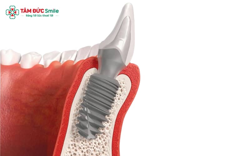 Cấu trúc trụ Tekka bao gồm Bone Level và Tissue Level, mang lại sự linh hoạt trong Abc8b tỷ lệ kèo World Cup 2026 Implant