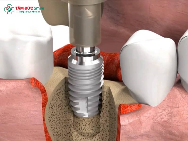 Trụ Implant Tekka Pháp: Đặc điểm, các loại và chứng nhận