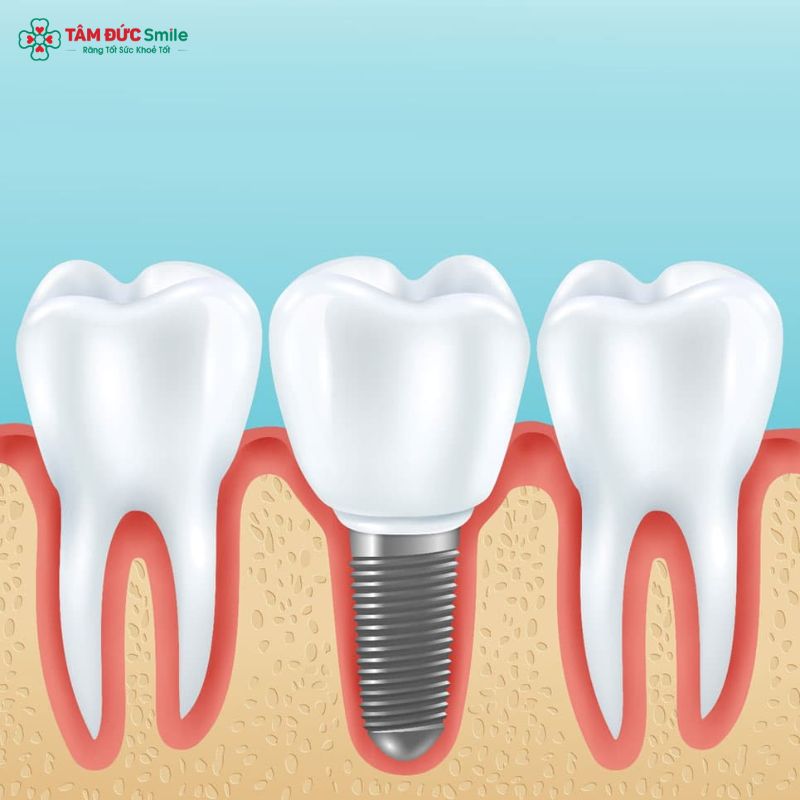 tru-implant-thuy-dien-2