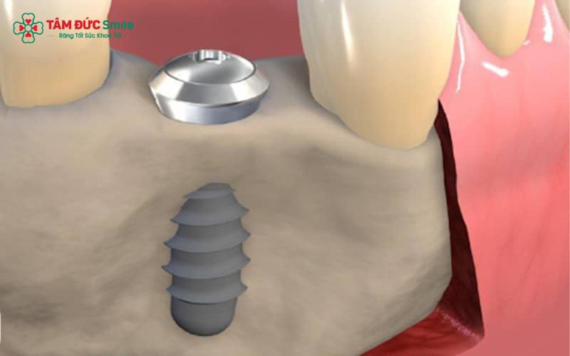 Implant Mis Đức ứng dụng Titanium tinh khiết, nổi bật với thiết kế ren xoắn của MIS C1