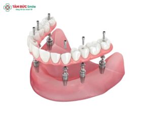 Trụ Implant Mis: Xuất xứ, cấu tạo, ưu điểm và lợi ích