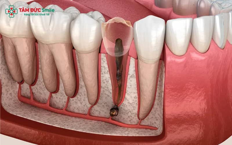 Tình trạng viêm Abc8com giaitri tructuyen có thể gây đau nhức, nướu đỏ, chảy máu và Abc8c1 com thiên đường cá cược hôi