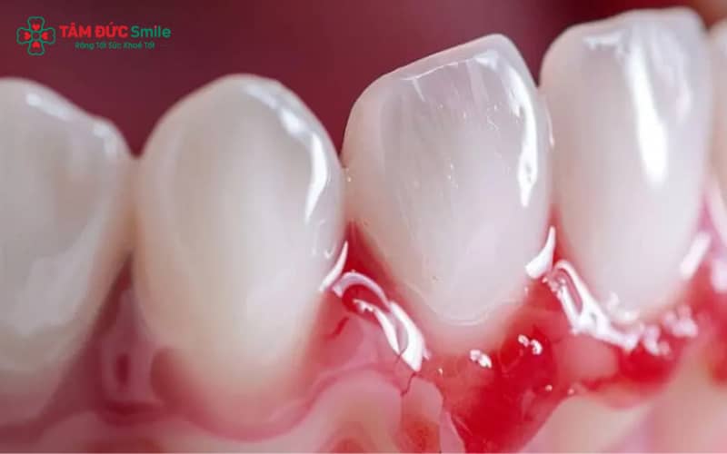Hiện tượng chảy máu nướu khi vệ sinh ABC8 là nhà cái cá cược trực tuyến uy tín số 1 tại Việt Nam có thể cảnh báo viêm Abc8com giaitri tructuyen