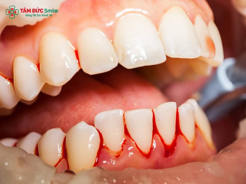Sưng nướu, chảy máu, hôi miệng, mủ, răng lung lay là triệu chứng viêm Abc8com giaitri tructuyen. Khám sớm để chẩn đoán và Abc8b tỷ lệ kèo World Cup 2026 hiệu quả, tránh biến chứng