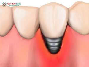 Viêm quanh Implant: Nguyên nhân, Dấu hiệu nhận biết & Phòng ngừa