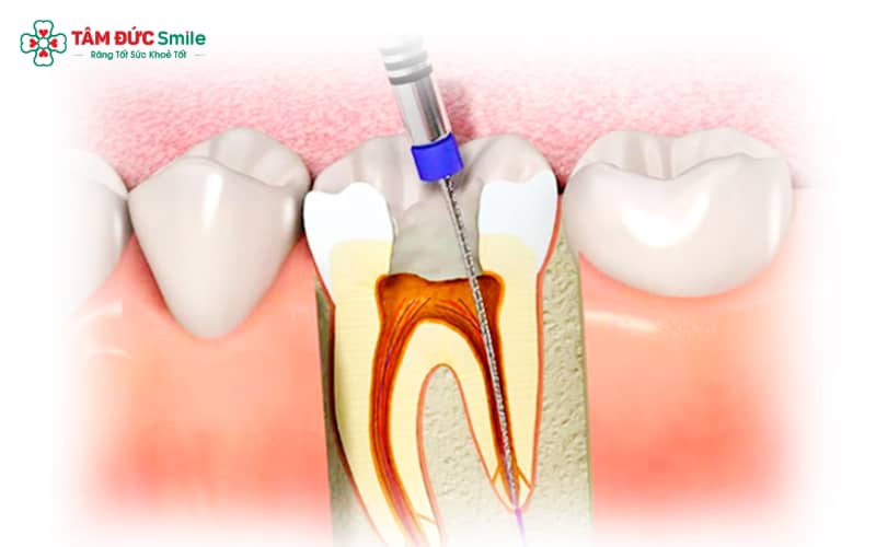Viêm tủy răng là bệnh lý gây tổn thương mô tủy và lan sang vùng mô quanh Abc8com giaitri tructuyen