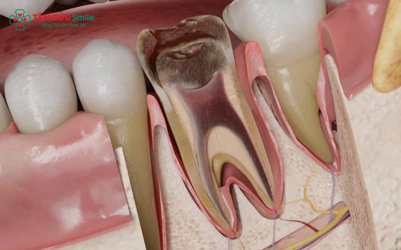Chữa tủy là kỹ thuật lấy bỏ mô tủy viêm, hàn kín ống tủy; trong trường hợp nghiêm trọng cần nhổ răng