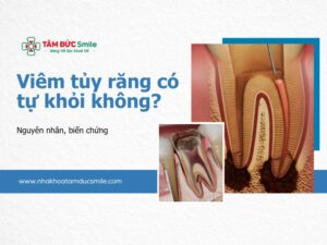 viem-tuy-rang-co-tu-khoi-khong-5