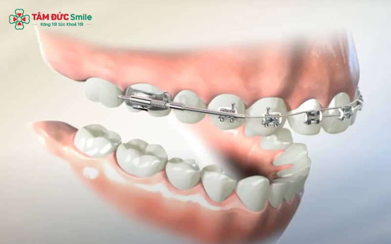 Niềng một hàm chỉ được chỉ định cho những trường hợp răng lệch nhẹ, đảm bảo khớp cắn chuẩn sau khi kết thúc Abc8b tỷ lệ kèo World Cup 2026