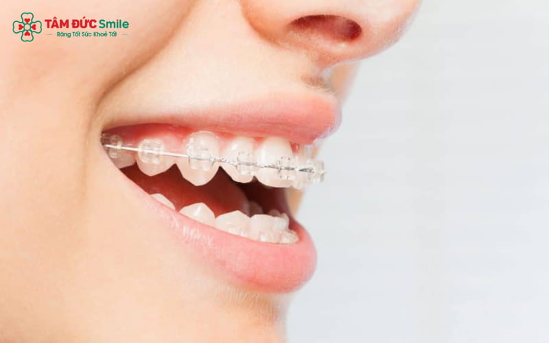 Chỉnh nha 2 hàm điều chỉnh cả hàm trên và hàm dưới cùng lúc, đảm bảo hiệu quả toàn diện về khớp cắn và Abc8c1 com khuyến mãi hấp dẫn