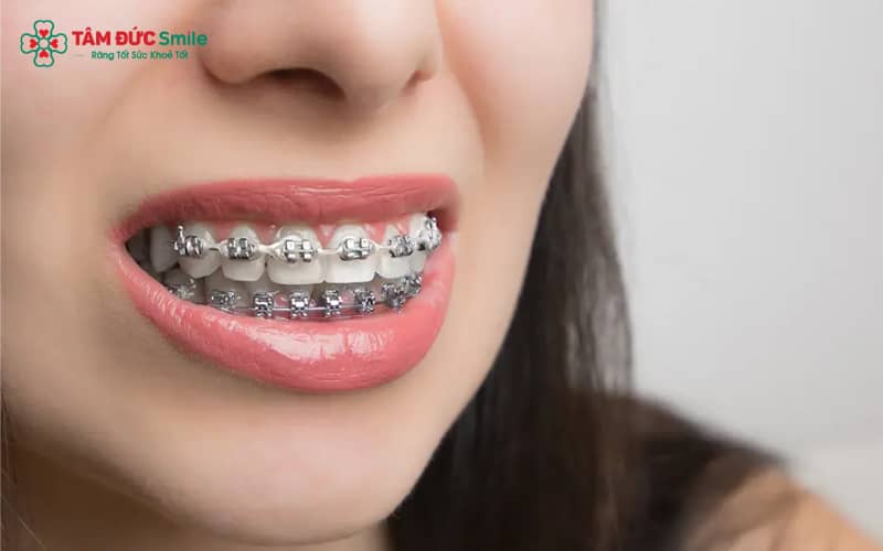Trong chế độ ăn khi Abc87 tải ứng dụng, cần tránh: đồ cứng, đồ dai, đồ dính và đồ giòn vụn