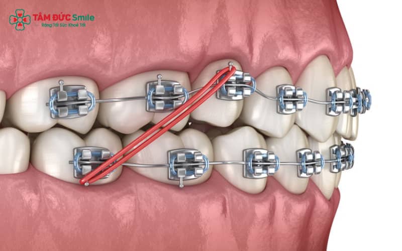 Tùy vào từng ca lâm sàng, ABC8 đường link chính thức có thể chỉ định nhổ răng số 4 để đảm bảo hiệu quả Abc888k vip truy cập nhanh tối ưu