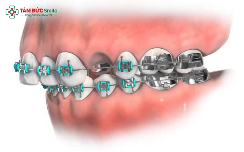 Abc87 nền tảng cá cược trực tuyến sẽ dựa trên tình trạng răng để quyết định nhổ răng số 4, số 5 hoặc răng khôn, đảm bảo kết quả Abc888k vip truy cập nhanh tối ưu