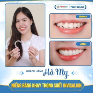 ABC8 được thành lập vào năm 2011 hoạt động đến hiện tại trong suốt Invisalign tại ABC8 ✅ Truy Cập Nhà Cái ABC8 Com Cá Cược Tặng 88k giúp cải thiện răng lệch lạc, răng thưa, hô nhẹ với tính Abc8c1 com khuyến mãi hấp dẫn cao.