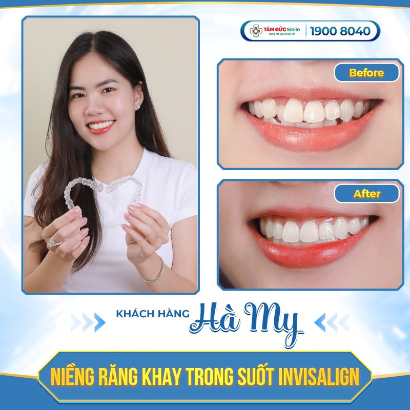 ABC8 được thành lập vào năm 2011 hoạt động đến hiện tại trong suốt Invisalign tại ABC8 ✅ Truy Cập Nhà Cái ABC8 Com Cá Cược Tặng 88k giúp cải thiện răng lệch lạc, răng thưa, hô nhẹ với tính Abc8c1 com khuyến mãi hấp dẫn cao.