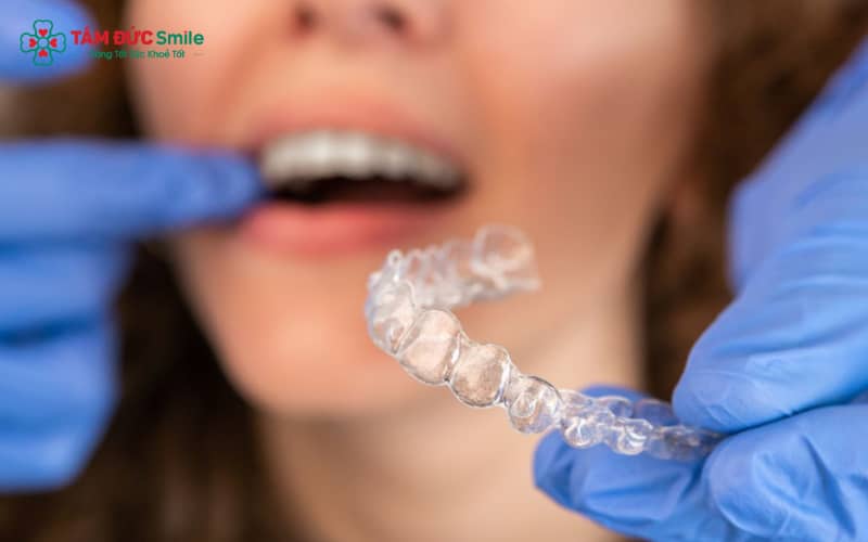 Bệnh nhân Invisalign có thể thấy ê nhẹ, đau và khó chịu trong vài ngày đầu hoặc sau mỗi lần đổi khay.