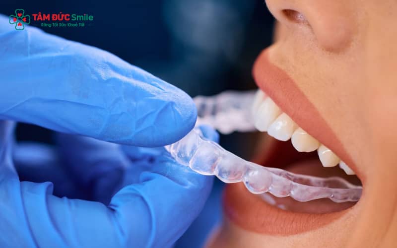 Niềng Invisalign thường gây ê nhẹ ban đầu, nhưng sau 1–2 tuần răng sẽ ổn định hơn và ít đau nhức.