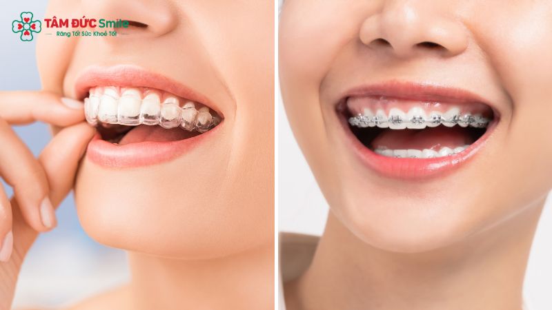 nieng-rang-invisalign-co-hieu-qua-khong-3