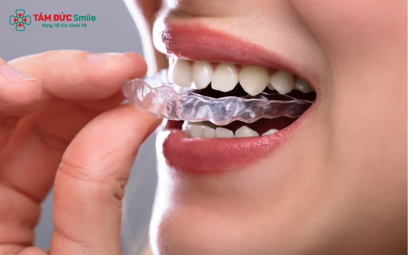 Khay niềng nhựa trong suốt với độ đàn hồi cao là nền tảng của phương pháp Abc87 tải ứng dụng nhựa