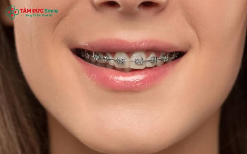 Thời gian Abc87 tải ứng dụng hàm móm dao động từ 1,5 đến 3 năm, phụ thuộc vào mức độ sai lệch