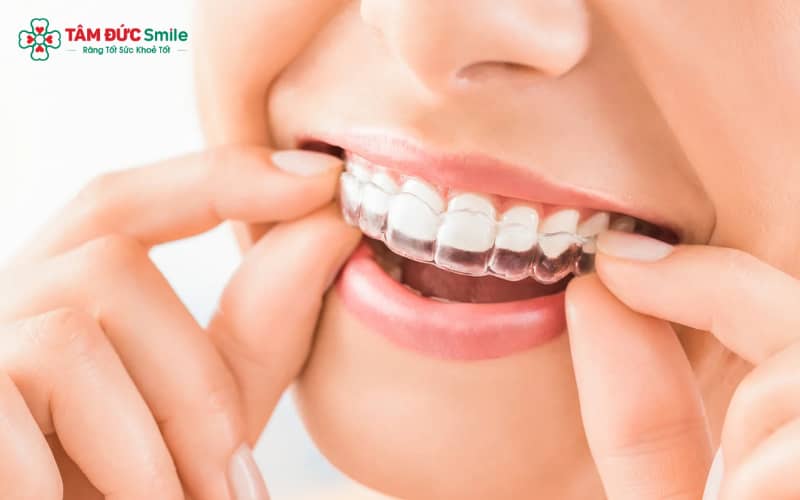 So với Abc87 tải ứng dụng mắc cài, Abc87 tải ứng dụng trong suốt thường gây ra mức độ đau và khó chịu thấp hơn