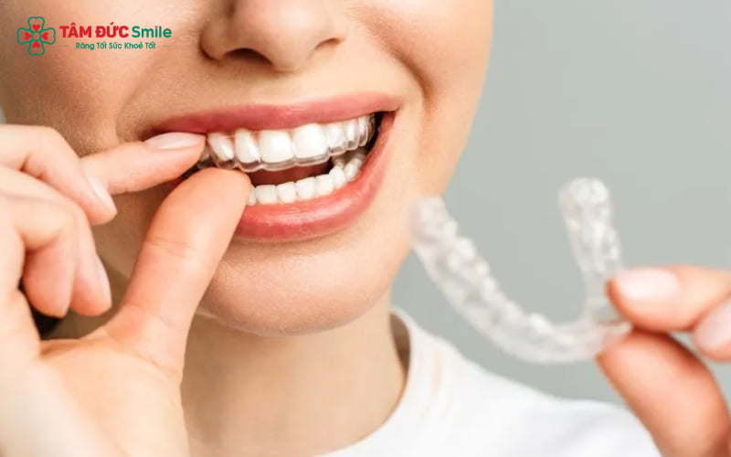 Áp lực từ khay niềng lên răng gây ra cảm giác đau nhẹ, thường gặp trong những ngày đầu hoặc khi thay sang khay mới