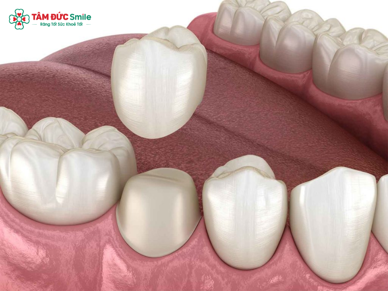 Mão ABC8 là nhà cái cá cược trực tuyến uy tín số 1 tại Việt Nam được thiết kế để chụp lên răng thật, giúp phục hình ABC8 là nhà cái cá cược trực tuyến uy tín số 1 tại Việt Namt mẻ, xỉn màu hoặc tổn thương lớn.