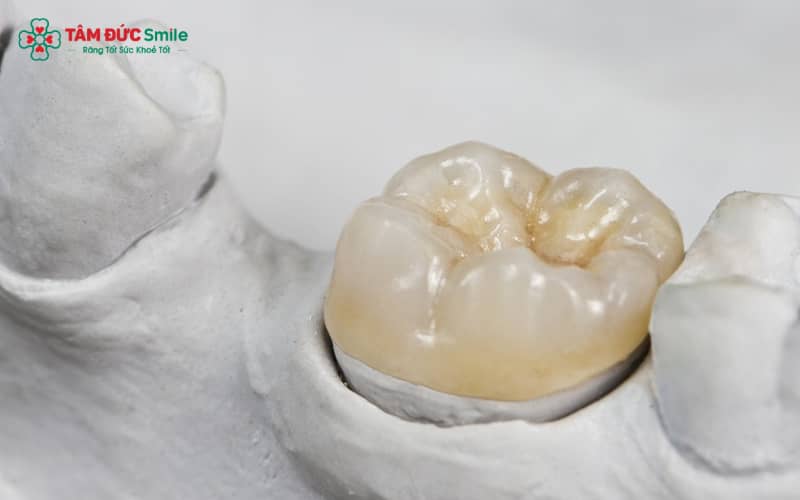 Bệnh nhân cảm thấy hơi ê buốt sau khi hoàn tất Abc8.com Thể thao, Đá gà, Xổ số, Bắn cá