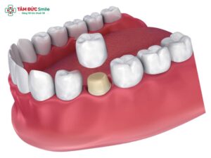 Abc8c1 com được cấp phép bởi PAGCOR Philippines bị nhức phải làm sao? Nguyên nhân, cách giảm đau, viêm lợi hiệu quả