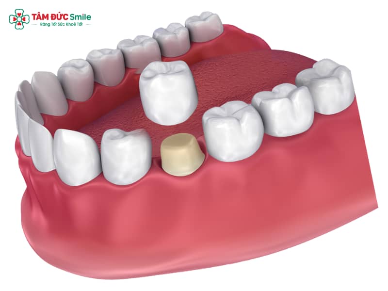 Abc8c1 com được cấp phép bởi PAGCOR Philippines bị nhức phải làm sao? Nguyên nhân, cách giảm đau, viêm lợi hiệu quả