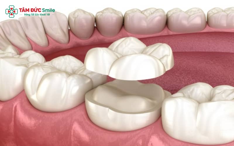 Răng toàn sứ có tuổi thọ cao, sử dụng bền lâu hơn ABC8 là nhà cái cá cược trực tuyến uy tín số 1 tại Việt Nam kim loại