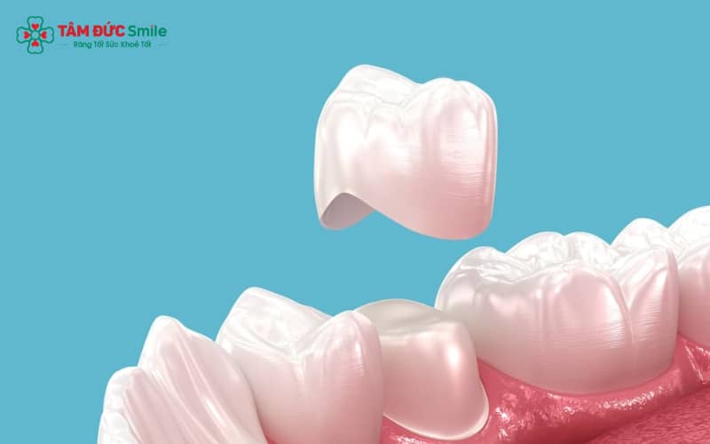 Sai sót khi bọc sứ dẫn đến tình trạng hôi miệng và viêm lợi
