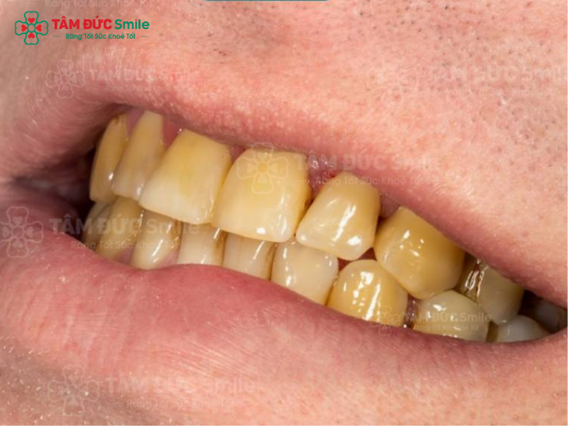 boc-rang-su-co-tot-khong-5
