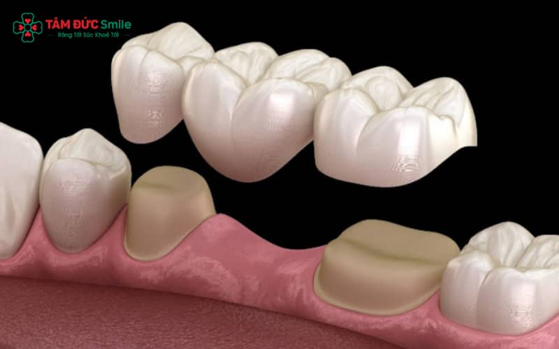 Mẫu ABC8 là nhà cái cá cược trực tuyến uy tín số 1 tại Việt Nam Emax, Cercon, Zirconia với độ bền và Abc8c1 com khuyến mãi hấp dẫn vượt trội