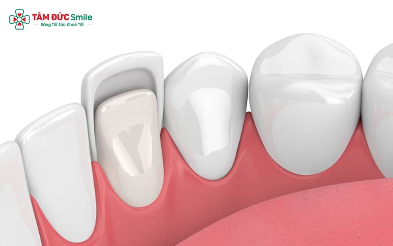 Kỹ thuật Abc8.com Thể thao, Đá gà, Xổ số, Bắn cá đòi hỏi mài một phần nhỏ men răng để tạo hình và gắn lớp sứ Abc8c1 com khuyến mãi hấp dẫn
