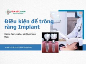 dieu-kien-de-trong-rang-implant