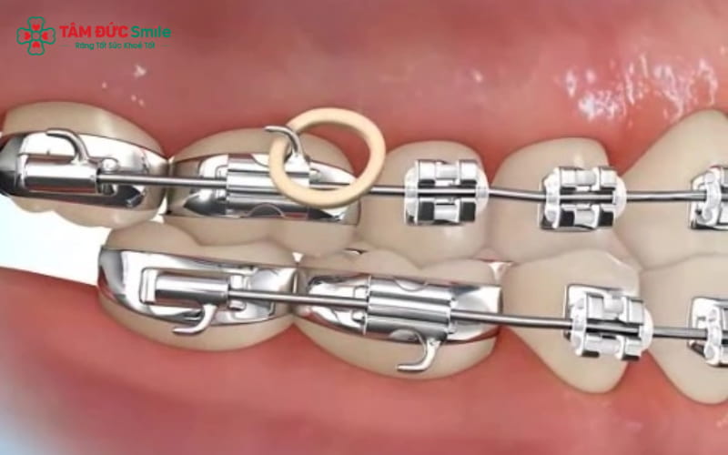 Gắn khâu Abc87 tải ứng dụng là kỹ thuật sử dụng vòng band kim loại cố định trên răng hàm