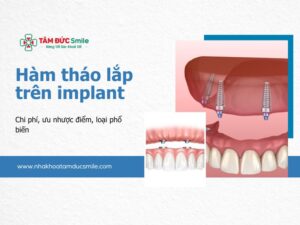 ham-thao-lap-tren-implant-5