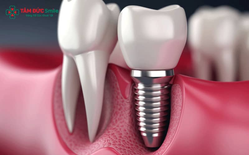 Trụ implant Thụy Sĩ sử dụng titanium, vật liệu đạt chuẩn y khoa và được ứng dụng phổ biến trong lĩnh vực LINK TRANG CHỦ ABC88 CHUẨN 2026