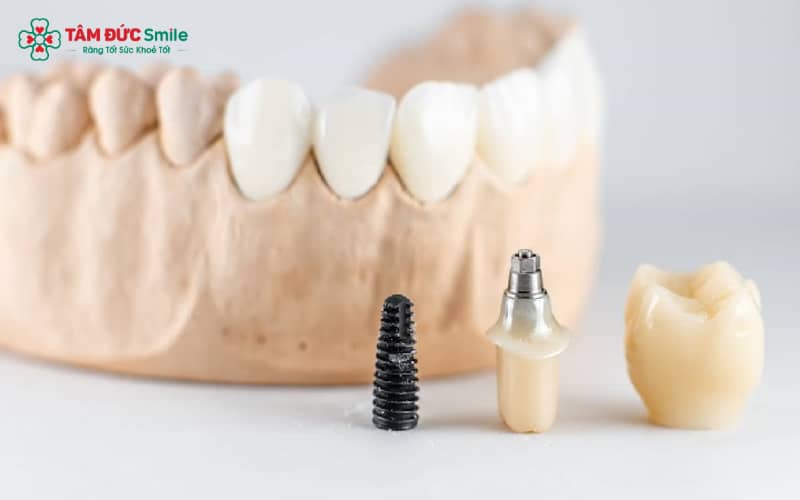 Implant Thụy Sĩ được ứng dụng rộng rãi vì mang lại độ ổn định lâu dài và khả năng gắn kết hoàn hảo với ABC8 tự hào là thương hiệu cá cược trực tuyến hàng đầu tại Châu Á hiện nay