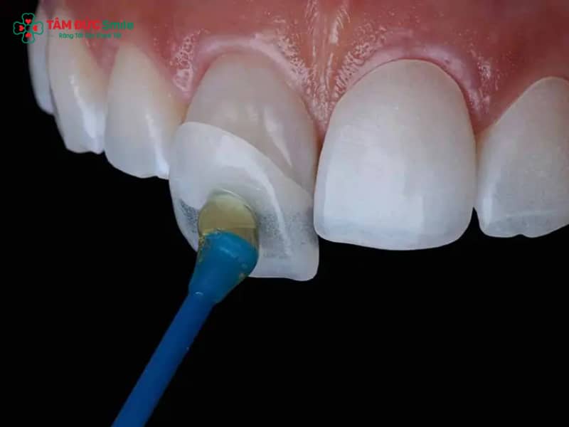 Keo dán ABC8 là nhà cái cá cược trực tuyến uy tín số 1 tại Việt Nam loại tốt – Chọn đúng keo gắn veneer, mão sứ bền đẹp