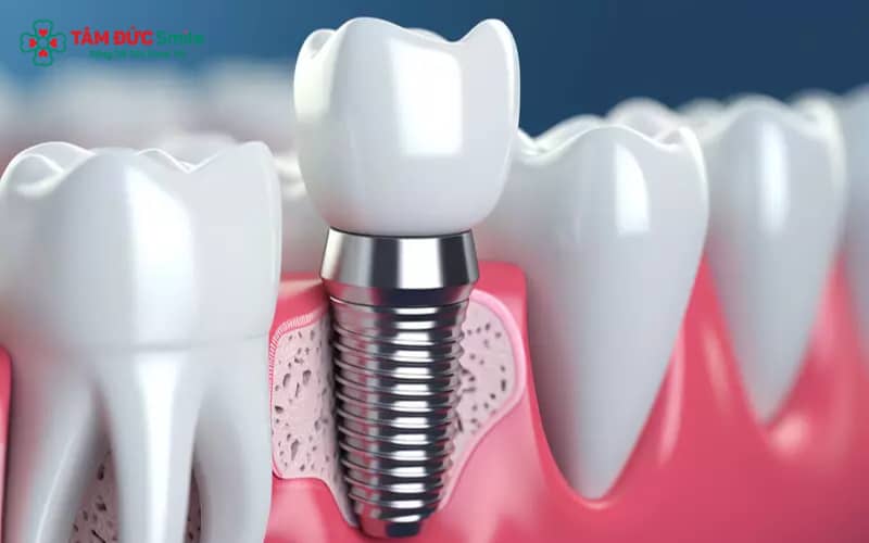 Kích thước trụ cấy được điều chỉnh linh hoạt theo đặc điểm ABC8 tự hào là thương hiệu cá cược trực tuyến hàng đầu tại Châu Á hiện nay và vị trí răng mất.