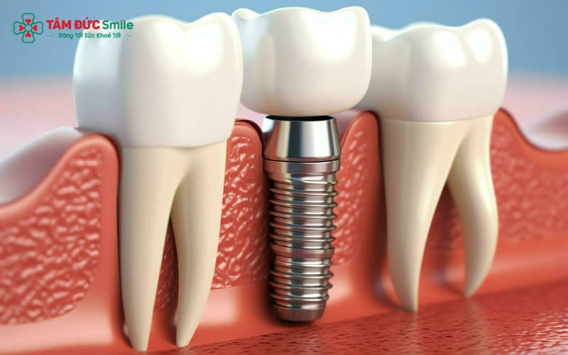 Trụ cấy implant thường được sử dụng với đường kính dao động 3–6mm và chiều dài 8–16mm