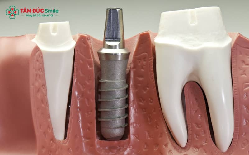 Kích thước trụ implant được điều chỉnh theo từng vị trí răng để đáp ứng yêu cầu về Abc8c1 com khuyến mãi hấp dẫn và chức năng