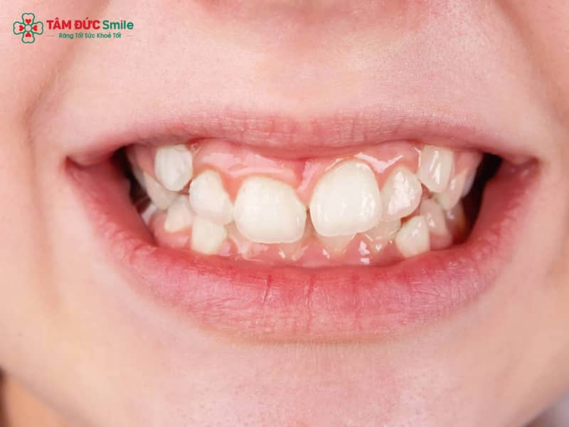Chỉnh nha giúp sắp xếp lại Abc8.com link truy cập, cải thiện tình trạng mọc dư đến 36 răng