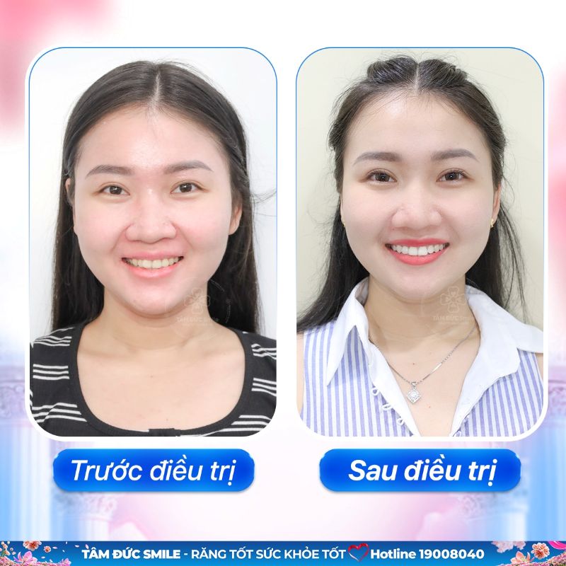 nha-khoa-tam-duc-smile-gia-kiem-5
